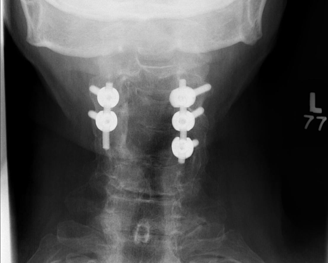 Cervical Pedicle Screws Lateral